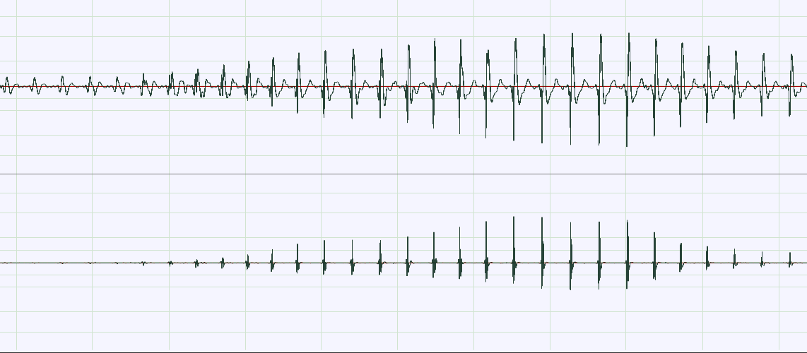 Measured raw acoustic signal above and its filtered envelope below, across one full cuff deflation